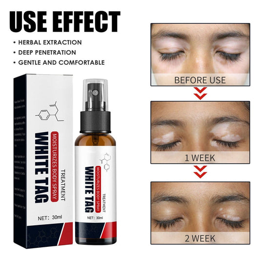 White Tag Vitiligo Spray