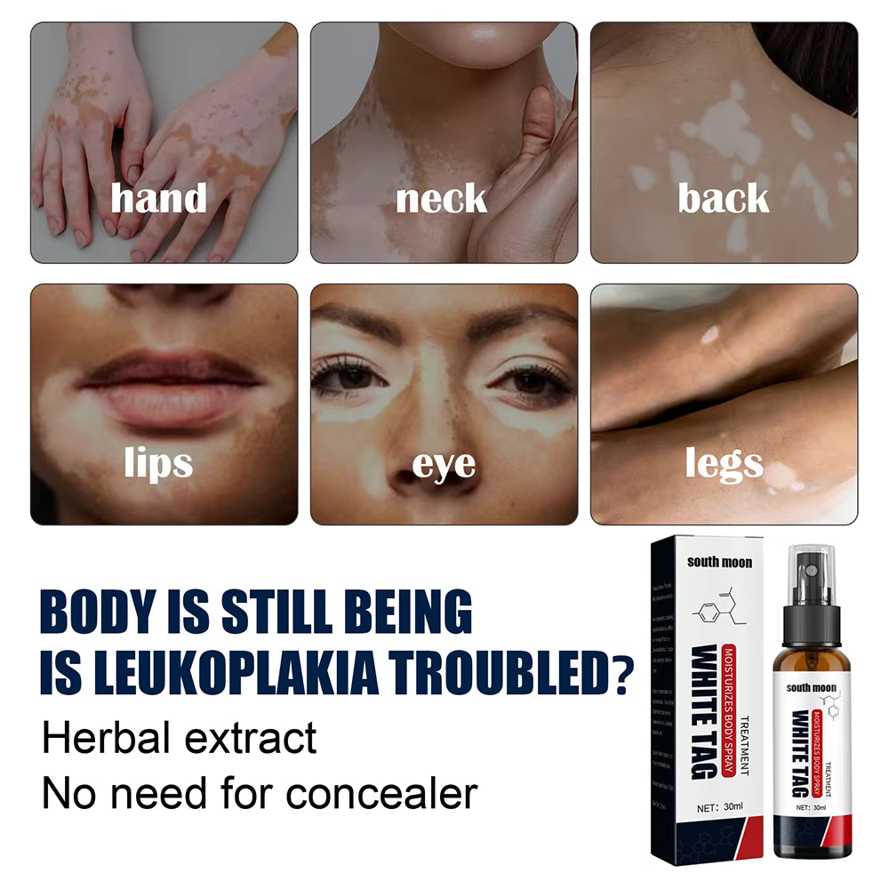 White Tag Vitiligo Spray