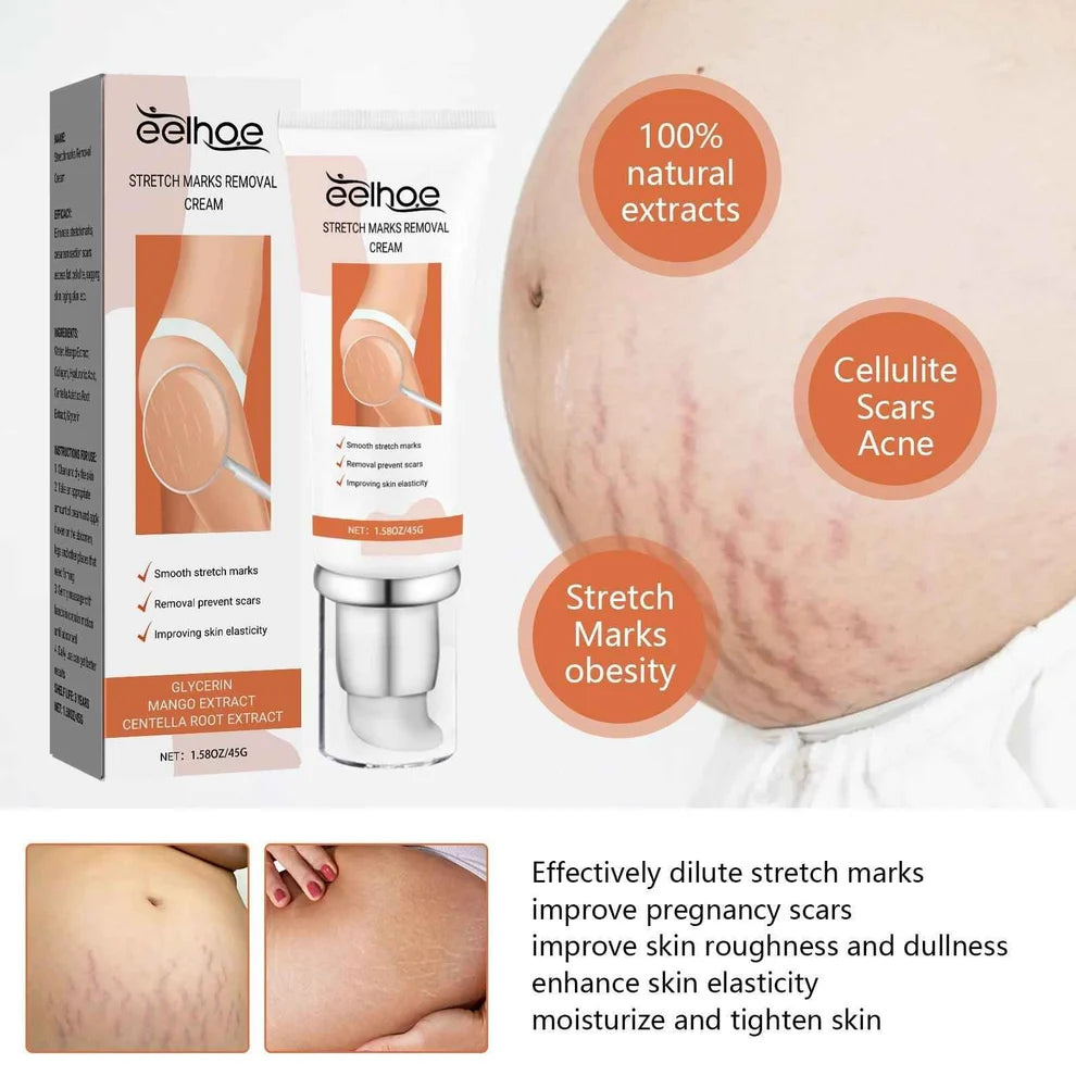 Anti Stretch Mark oil for Postpartum and Obesity