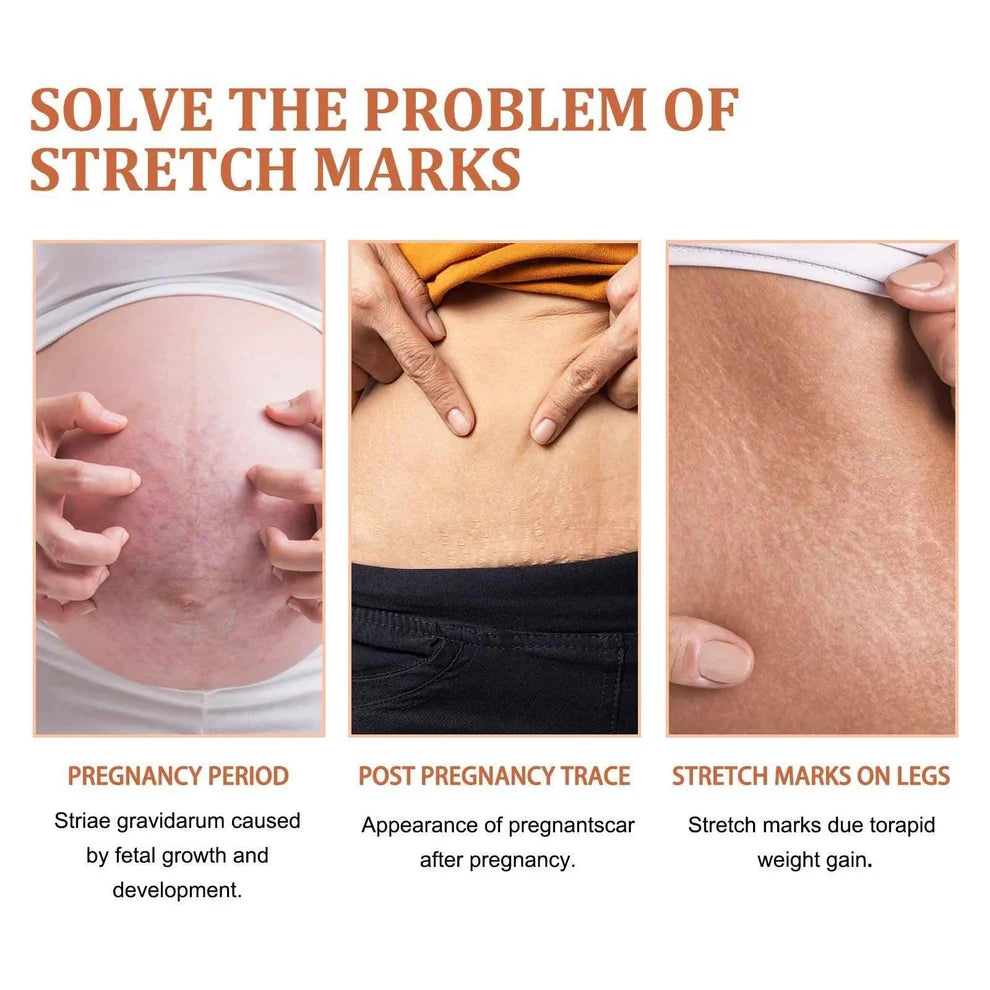 Anti Stretch Mark oil for Postpartum and Obesity