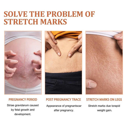 Anti Stretch Mark oil for Postpartum and Obesity